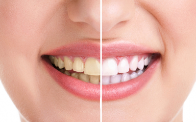 Không muốn răng bị xỉn màu: Hạn chế 10 loại thực phẩm sau
