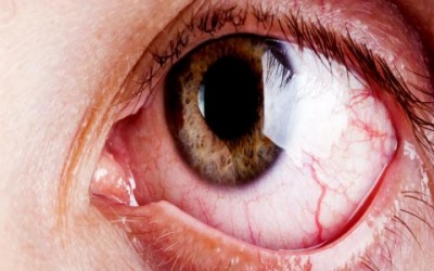 Viêm màng bồ đào dễ nhầm với đau mắt đỏ