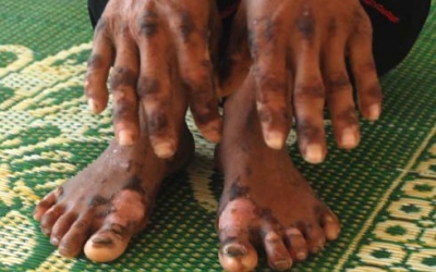 Biểu hiện của nhiễm độc thạch tín (asen)