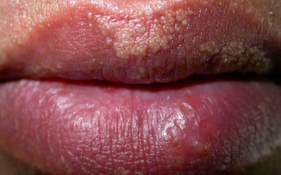 Mọc mụn trắng li ti ở môi là bệnh gì?