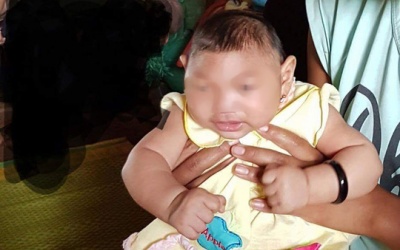 Bất ngờ phát hiện thêm 2 em bé bị chứng đầu nhỏ