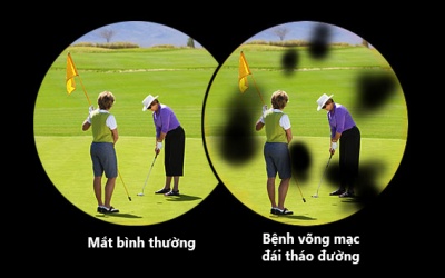 Bệnh mắt vì đái tháo đường: Bổ sung omega-3 có ăn thua?