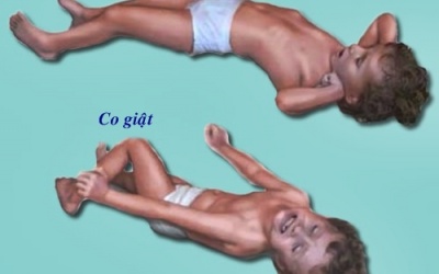 Biểu hiện của các cơn co giật ở trẻ