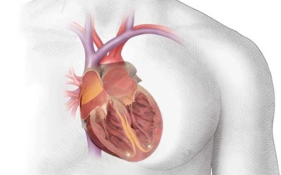 Các triệu chứng của bệnh rung nhĩ cảnh báo nguy hiểm