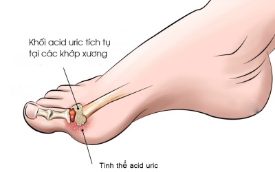Các biện pháp tự nhiên giúp giảm acid uric