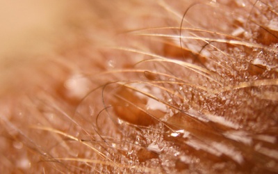 Đổ mồ hôi quá mức có thể là dấu hiệu của nhiều bệnh