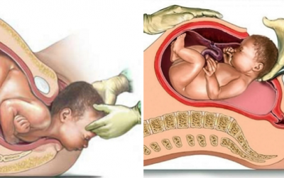 Sinh thường và sinh mổ: So sánh lợi ích, tác hại giúp mẹ thêm vững tin