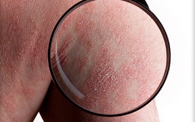 Tinh dầu có giúp hỗ trợ điều trị vẩy nến?