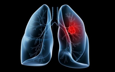 Liệu bạn có thực sự hiểu rõ về bệnh ung thư phổi?