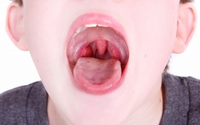 Viêm amidan có thể chữa khỏi mà không cần cắt?