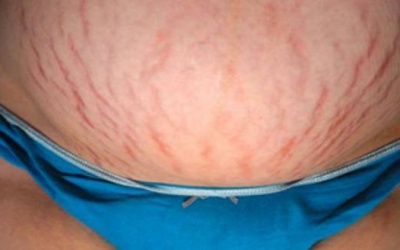 Da nhăn nheo, chảy xệ sau sinh phải làm sao?