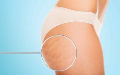 7 sự thật thú vị về hiện tượng da sần vỏ cam 