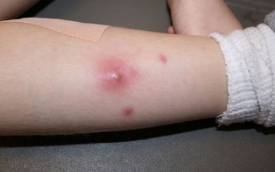 Phân biệt mụn nhọt thường và nhọt độc