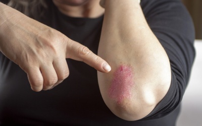 Vẩy nến ở khuỷu tay phải làm sao?