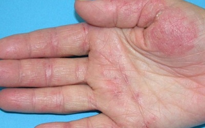 Làm gì khi bị viêm da cơ địa?