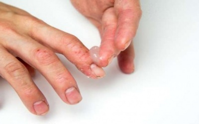 Tác dụng phụ đáng sợ của thuốc bôi Corticoid