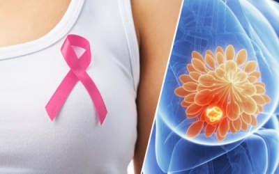 Những dấu hiệu bệnh ung thư vú ít khi được chú ý