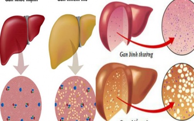 Điều trị bệnh gan nhiễm mỡ thế nào?