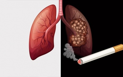 Ung thư phổi: Liệu bạn có nguy cơ mắc bệnh?
