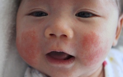 Bệnh chàm Eczema và 5 biện pháp tự nhiên hỗ trợ điều trị