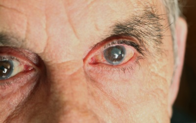 2 mắt bị đục thủy tinh thể có nên phẫu thuật cả 2 cùng 1 lúc? 