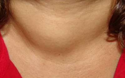 U tuyến giáp đa nhân lành tính phải làm sao?