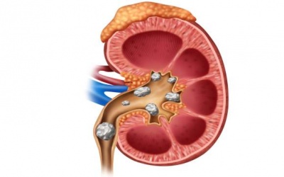 Tái phát sỏi thận vì những nguyên nhân không ngờ