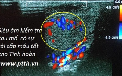 Việt Nam lần đầu nối ghép thành công hai tinh hoàn đứt rời cùng dương vật