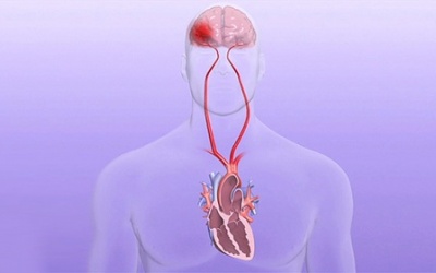 Người bệnh rung nhĩ bị tăng huyết áp cần cẩn thận nguy cơ đột quỵ