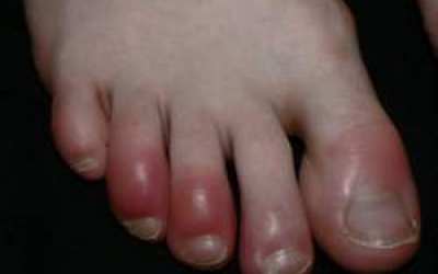 Những bài thuốc dân gian trị cước chân tay