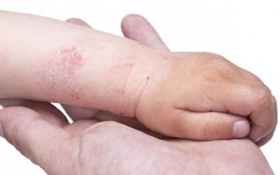 10 biện pháp tại nhà giúp bạn đối phó với bệnh eczema
