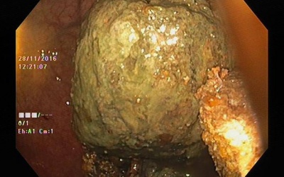 Tắc ruột sau khi ăn 3 quả hồng giòn