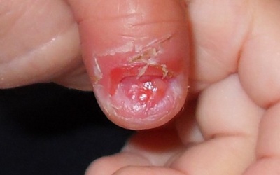 Sau bao lâu móng tay, móng chân bị bật có thể mọc lại?