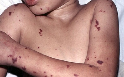 Bệnh viêm não mô cầu có dễ lây hay không?