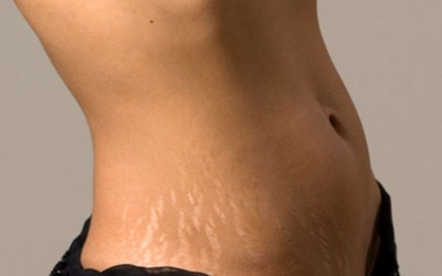 Rạn da do tăng cân quá nhanh phải làm sao?