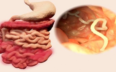 6 dấu hiệu cảnh báo bạn đã bị nhiễm sán dây