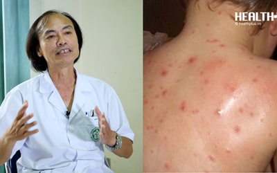 Con nổi mụn khắp người vì mẹ tự ý mua thuốc kháng sinh và 'bắt bệnh' qua mạng