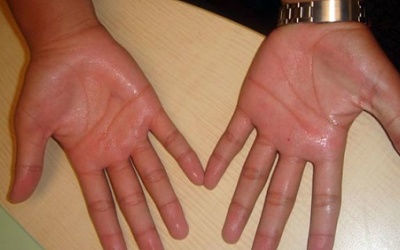 Viêm tuyến mồ hôi có đáng ngại?