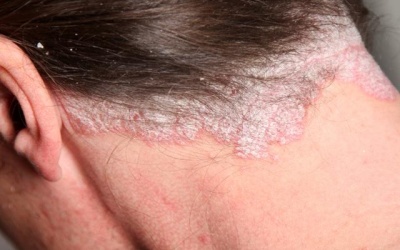 Bị vẩy nến chân tóc có dùng kem thảo dược Explaq?