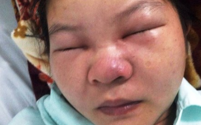 Cứu nữ bệnh nhân suýt chết vì… nặn mụn