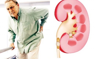 Ăn uống thế nào giúp ngăn ngừa suy thận?