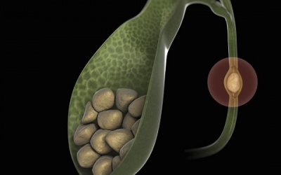 Bạn đã biết gì về bệnh túi mật và các triệu chứng bệnh?