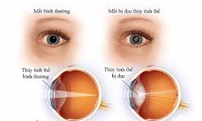 Có thể làm lại phẫu thuật đục thủy tinh thể không?