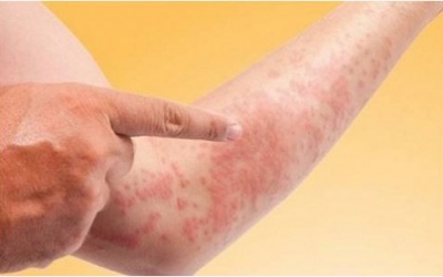 42 công nhân nhập viện nghi do dị ứng thức ăn