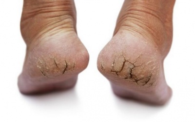Cách chữa nứt gót chân siêu đơn giản mà bạn chưa biết