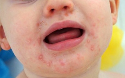 Gel làm sạch Subạc có tác dụng thế nào với bệnh tay chân miệng?