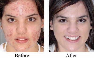 Làm sao để trị sẹo do mụn trứng cá một cách hiệu quả?