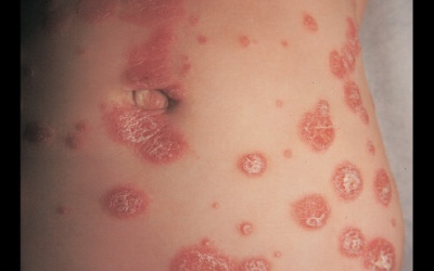 Mối liên hệ giữa vẩy nến và vitamin D