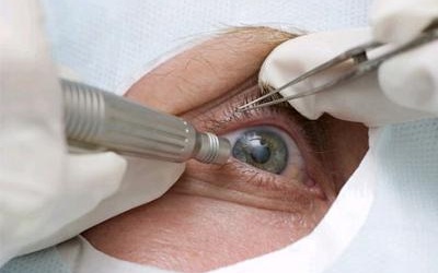 Phẫu thuật thay thủy tinh thể nhưng mắt vẫn mờ, phải làm sao?