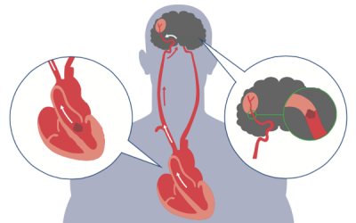 Rung tâm nhĩ và các nguy cơ biến chứng bạn cần cảnh giác
